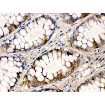 FABP1 / L-FABP Antibody - liver FABP antibody IHC-paraffin. IHC(P): Human Intestinal Cancer Tissue.