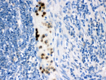 FABP3 / H-FABP Antibody - IHC testing of FFPE human intestinal cancer tissue with FABP3 antibody.