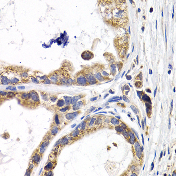 FABP3 / H-FABP Antibody - Immunohistochemistry of paraffin-embedded human stomach cancer tissue.
