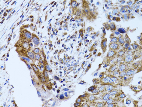FABP4 / AP2 Antibody - Immunohistochemistry of paraffin-embedded human breast cancer using FABP4 antibodyat dilution of 1:100 (40x lens).
