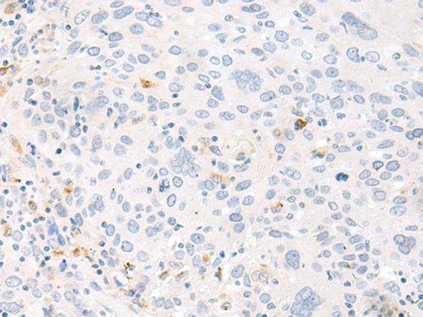 FABP4 / AP2 Antibody - Immunohistochemistry of paraffin-embedded Human cervical cancer tissue  using FABP4 Polyclonal Antibody at dilution of 1:60(×200)
