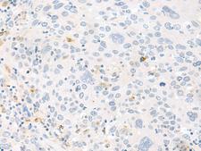FABP4 / AP2 Antibody - Immunohistochemistry of paraffin-embedded Human cervical cancer tissue  using FABP4 Polyclonal Antibody at dilution of 1:60(×200)