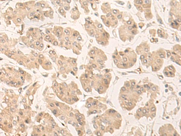 FABP4 / AP2 Antibody - Immunohistochemistry of paraffin-embedded Human gastric cancer tissue  using FABP4 Polyclonal Antibody at dilution of 1:60(×200)