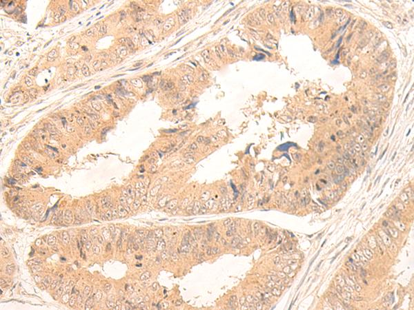 FABP4 / AP2 Antibody - Immunohistochemistry of paraffin-embedded Human colorectal cancer tissue  using FABP4 Polyclonal Antibody at dilution of 1:65(×200)