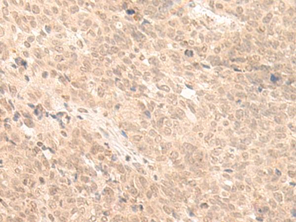 FABP4 / AP2 Antibody - Immunohistochemistry of paraffin-embedded Human ovarian cancer tissue  using FABP4 Polyclonal Antibody at dilution of 1:65(×200)