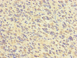 FABP7 / BLBP / MRG Antibody - Immunohistochemistry of paraffin-embedded human glioma cancer at dilution of 1:100