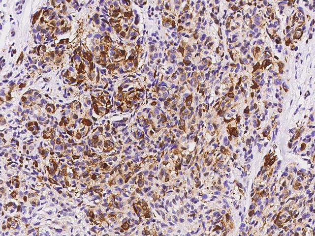 FABP7 / BLBP / MRG Antibody - Immunochemical staining of human FABP7 in human malignant melanoma with rabbit polyclonal antibody at 1:5000 dilution, formalin-fixed paraffin embedded sections.