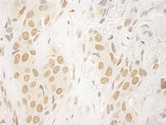 FAC1 / BPTF Antibody - FFPE section of human breast carcinoma.  Rabbit anti-FALZ/BPTF IHC Antibody, Affinity Purified used at a dilution of 1:250.