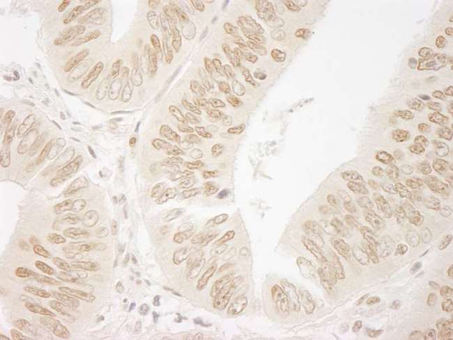 FAC1 / BPTF Antibody - FFPE section of human colon carcinoma. Rabbit anti-FALZ/BPTF IHC Antibody, Affinity Purified used at a dilution of 1:250.