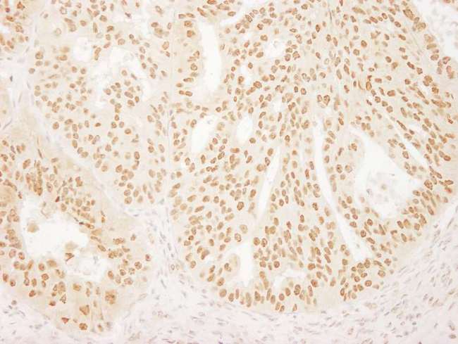 FAC1 / BPTF Antibody - Detection of Human FALZ/BPTF by Immunohistochemistry. Sample: FFPE section of human ovarian carcinoma. Antibody: Affinity purified rabbit anti-FALZ/BPTF used at a dilution of 1:200 (1 Detection: DAB.