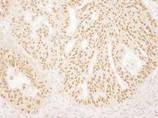 FAC1 / BPTF Antibody - Detection of Human FALZ/BPTF by Immunohistochemistry. Sample: FFPE section of human ovarian carcinoma. Antibody: Affinity purified rabbit anti-FALZ/BPTF used at a dilution of 1:200 (1 Detection: DAB.