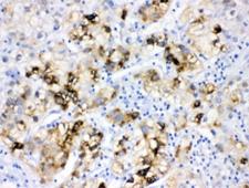 FACL2 / ACSL1 Antibody - IHC testing of FFPE human liver cancer tissue with ACSL1 antibody at 1ug/ml. HIER: steam sections in pH6 citrate buffer for 20 min.