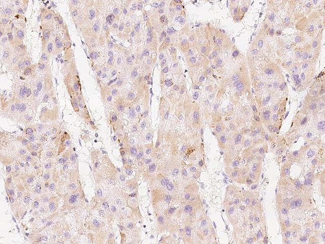 FACL2 / ACSL1 Antibody - Immunochemical staining of human ACSL1 in human hepatoma with rabbit polyclonal antibody at 1:300 dilution, formalin-fixed paraffin embedded sections.