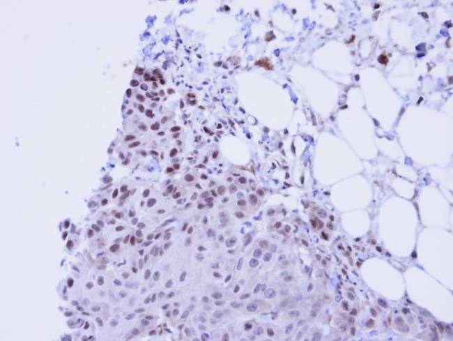 FACT / SSRP1 Antibody - IHC of paraffin-embedded Cal27 Xenograft using SSRP1 antibody at 1:100 dilution.