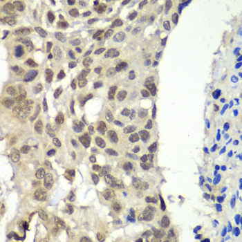FACT / SSRP1 Antibody - Immunohistochemistry of paraffin-embedded human esophageal cancer tissue.