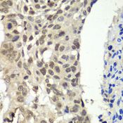 FACT / SSRP1 Antibody - Immunohistochemistry of paraffin-embedded human esophageal cancer using SSRP1 antibody at dilution of 1:100 (40x lens).