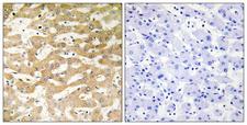 FADD Antibody - Immunohistochemistry analysis of paraffin-embedded human liver carcinoma tissue, using FADD Antibody. The picture on the right is blocked with the synthesized peptide.