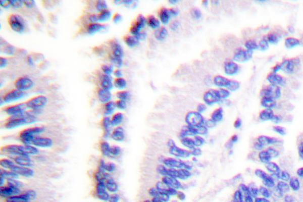 FADD Antibody - IHC of FADD (N188) pAb in paraffin-embedded human lung carcinoma tissue.