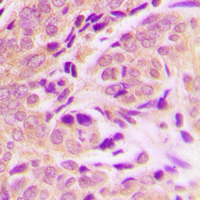 FADD Antibody - Immunohistochemical analysis of FADD staining in human breast cancer formalin fixed paraffin embedded tissue section. The section was pre-treated using heat mediated antigen retrieval with sodium citrate buffer (pH 6.0). The section was then incubated with the antibody at room temperature and detected using an HRP conjugated compact polymer system. DAB was used as the chromogen. The section was then counterstained with hematoxylin and mounted with DPX.