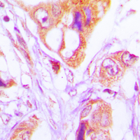 FADD Antibody - Immunohistochemical analysis of FADD staining in human lung cancer formalin fixed paraffin embedded tissue section. The section was pre-treated using heat mediated antigen retrieval with sodium citrate buffer (pH 6.0). The section was then incubated with the antibody at room temperature and detected using an HRP conjugated compact polymer system. DAB was used as the chromogen. The section was then counterstained with hematoxylin and mounted with DPX.