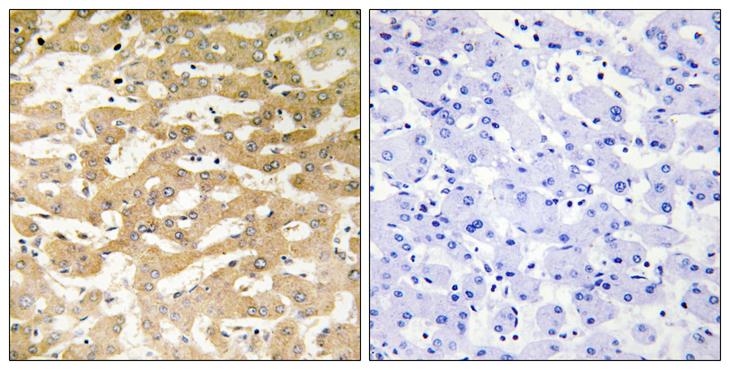 FADD Antibody - Peptide - + Immunohistochemistry analysis of paraffin-embedded human liver carcinoma tissue using FADD antibody.