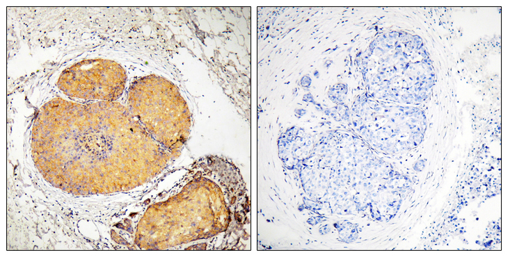 FADD Antibody - Immunohistochemistry analysis of paraffin-embedded human breast carcinoma, using FADD (Phospho-Ser191) Antibody. The picture on the right is blocked with the phospho peptide.