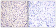 FADD Antibody - Immunohistochemistry analysis of paraffin-embedded human breast carcinoma, using FADD (Phospho-Ser194) Antibody. The picture on the right is blocked with the phospho peptide.
