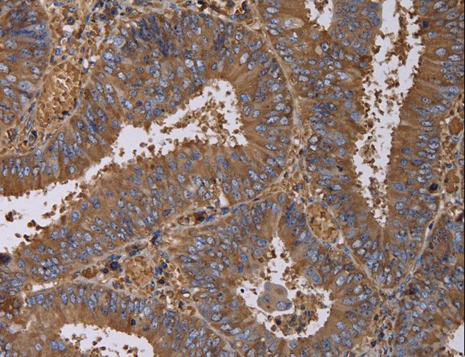 FADS1 Antibody - Immunohistochemistry of paraffin-embedded Human colon cancer using FADS1 Polyclonal Antibody at dilution of 1:60.