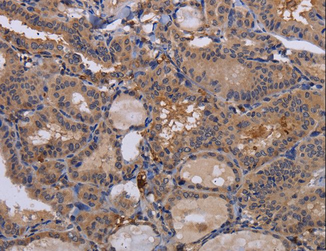 FADS1 Antibody - Immunohistochemistry of paraffin-embedded Human thyroid cancer using FADS1 Polyclonal Antibody at dilution of 1:60.