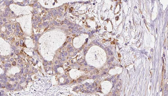 FAF2 / ETEA Antibody - 1:100 staining human liver carcinoma tissues by IHC-P. The sample was formaldehyde fixed and a heat mediated antigen retrieval step in citrate buffer was performed. The sample was then blocked and incubated with the antibody for 1.5 hours at 22°C. An HRP conjugated goat anti-rabbit antibody was used as the secondary.