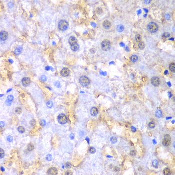 FAH Antibody - Immunohistochemistry of paraffin-embedded human liver injury using FAH antibody at dilution of 1:100 (40x lens).