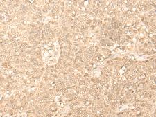 FAH Antibody - Immunohistochemistry of paraffin-embedded Human ovarian cancer tissue  using FAH Polyclonal Antibody at dilution of 1:40(×200)