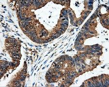 FAHD2A Antibody - IHC of paraffin-embedded Adenocarcinoma of colon tissue using anti-FAHD2A mouse monoclonal antibody. (Dilution 1:50).