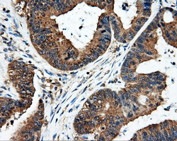 FAHD2A Antibody - IHC of paraffin-embedded Adenocarcinoma of colon tissue using anti-FAHD2A mouse monoclonal antibody. (Dilution 1:50).