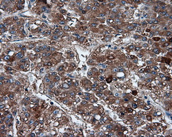 FAHD2A Antibody - Immunohistochemical staining of paraffin-embedded Carcinoma of liver tissue using anti-FAHD2A mouse monoclonal antibody. (Dilution 1:50).