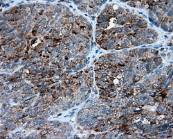 FAHD2A Antibody - Immunohistochemical staining of paraffin-embedded Adenocarcinoma of endometrium tissue using anti-FAHD2A mouse monoclonal antibody. (Dilution 1:50).