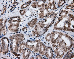 FAHD2A Antibody - IHC of paraffin-embedded Carcinoma of prostate tissue using anti-FAHD2A mouse monoclonal antibody. (Dilution 1:50).