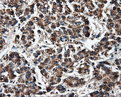 FAHD2A Antibody - IHC of paraffin-embedded Carcinoma of liver tissue using anti-FAHD2A mouse monoclonal antibody. (Dilution 1:50).