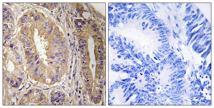 FAK / Focal Adhesion Kinase Antibody - Immunohistochemistry analysis of paraffin-embedded human colon carcinoma tissue, using FAK Antibody. The picture on the right is blocked with the synthesized peptide.