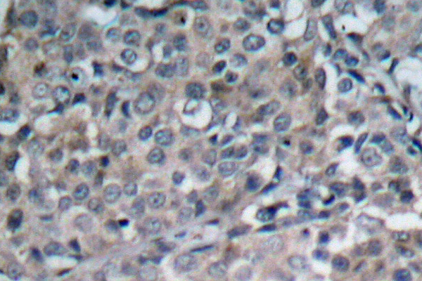 FAK / Focal Adhesion Kinase Antibody - IHC of FAK (R919) pAb in paraffin-embedded human breast carcinoma tissue.