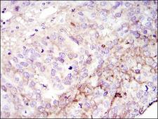 FAK / Focal Adhesion Kinase Antibody - IHC of paraffin-embedded cervices tumor using FAK mouse monoclonal antibody with DAB staining