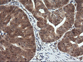 FAK / Focal Adhesion Kinase Antibody - IHC of paraffin-embedded Carcinoma of Human pancreas tissue using anti-PTK2 mouse monoclonal antibody.