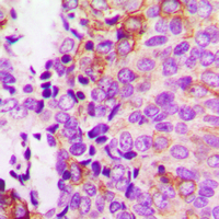 FAK / Focal Adhesion Kinase Antibody - Immunohistochemical analysis of Focal Adhesion Kinase (pY397) staining in human breast cancer formalin fixed paraffin embedded tissue section. The section was pre-treated using heat mediated antigen retrieval with sodium citrate buffer (pH 6.0). The section was then incubated with the antibody at room temperature and detected using an HRP-conjugated compact polymer system. DAB was used as the chromogen. The section was then counterstained with hematoxylin and mounted with DPX.