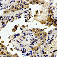 FAK / Focal Adhesion Kinase Antibody - Immunohistochemical analysis of Focal Adhesion Kinase (pY407) staining in human lung cancer formalin fixed paraffin embedded tissue section. The section was pre-treated using heat mediated antigen retrieval with sodium citrate buffer (pH 6.0). The section was then incubated with the antibody at room temperature and detected using an HRP polymer system. DAB was used as the chromogen. The section was then counterstained with hematoxylin and mounted with DPX.