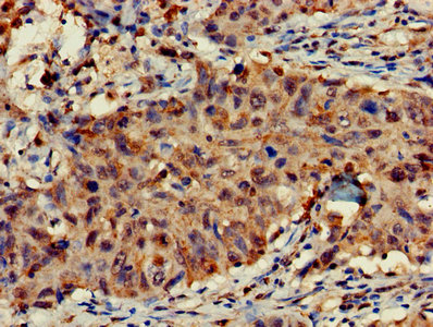 FAM107A / TU3A Antibody - Immunohistochemistry of paraffin-embedded human lung cancer using FAM107A Antibody at dilution of 1:100