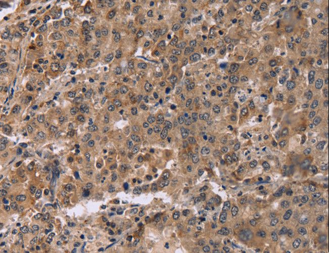 FAM107A / TU3A Antibody - Immunohistochemistry of paraffin-embedded Human colon cancer using FAM107A Polyclonal Antibody at dilution of 1:30.