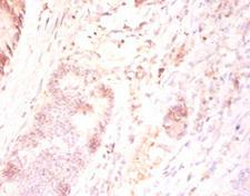 FAM110B / C8orf72 Antibody - Immunohistochemistry of paraffin-embedded human colon cancer using FAM110B Antibody at dilution of 1:50