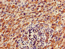 FAM111A Antibody - Immunohistochemistry of paraffin-embedded human liver cancer using FAM111A Antibody at dilution of 1:100