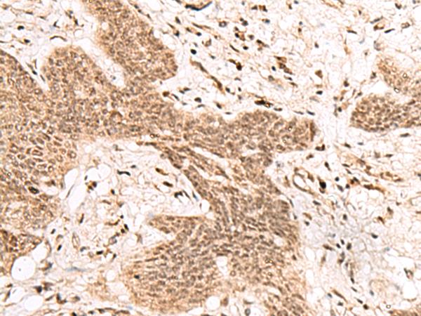 FAM111B Antibody - Immunohistochemistry of paraffin-embedded Human esophagus cancer tissue  using FAM111B Polyclonal Antibody at dilution of 1:50(×200)