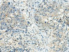 FAM116A Antibody - Immunohistochemistry of paraffin-embedded Human cervical cancer tissue  using PAK1IP1 Polyclonal Antibody at dilution of 1:120(×200)